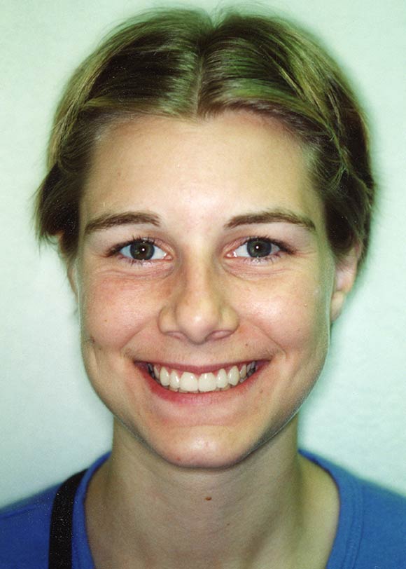 After veneers image of a girl at Gary R. Templeman, DDS. 