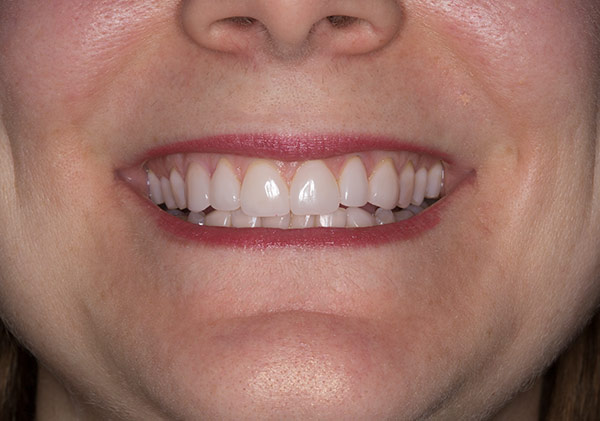 Teeth of 20 year veneer followup of a woman at Gary R. Templeman, DDS. 