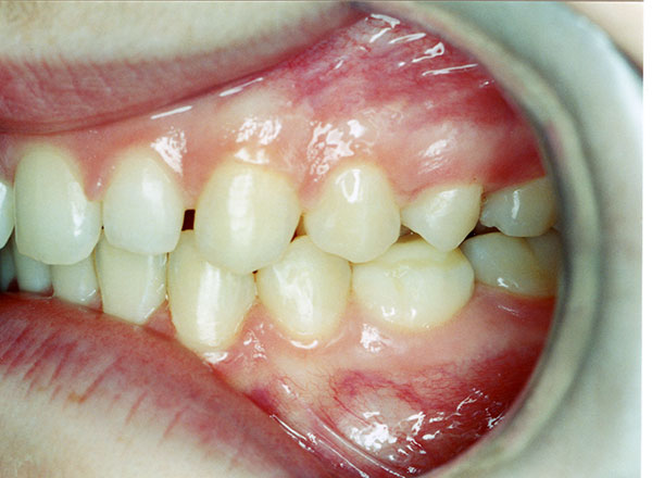 After orthodontics left side teeth at Gary R. Templeman, DDS. 